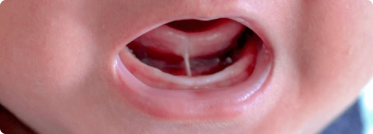 TMJ Connected to tongue ties