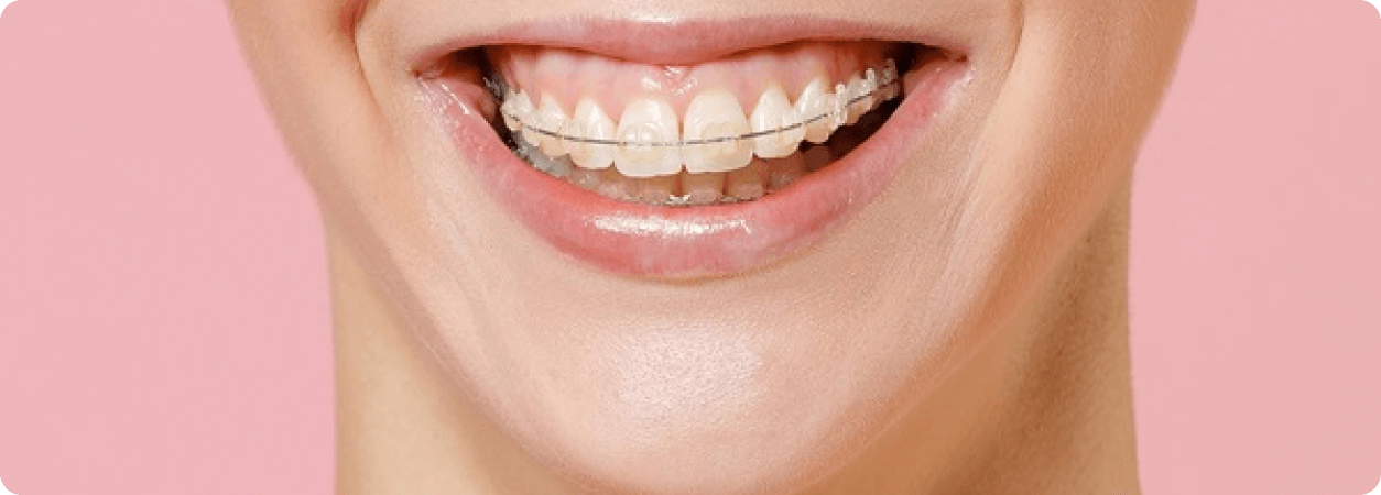 Orthodontic expansion in adults blogs