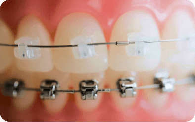 Damon braces