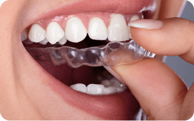 Illusion Aligners