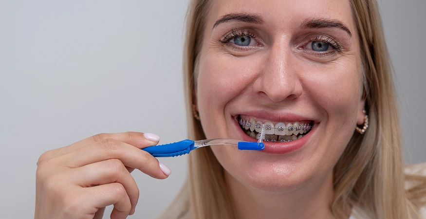 ceramic braces before and after