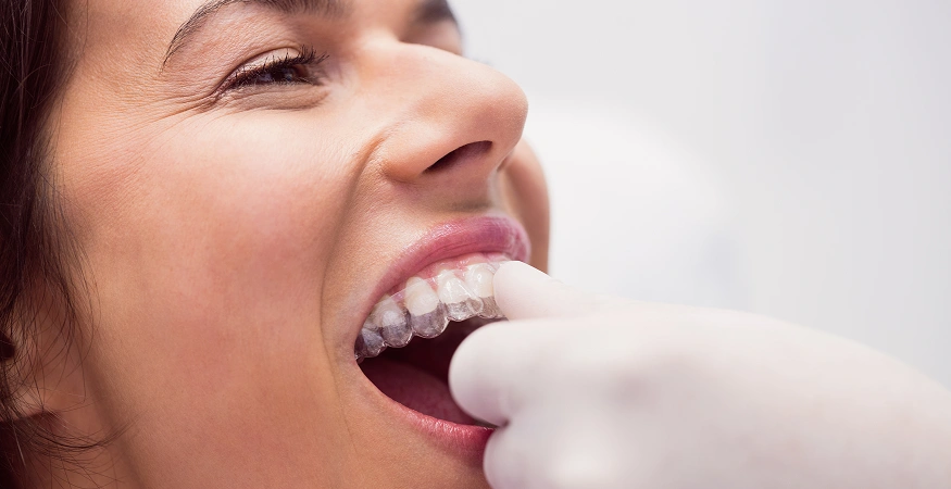 Treatment Options for crooked teeth smile