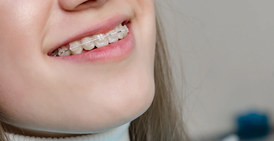 ceramic dental braces
