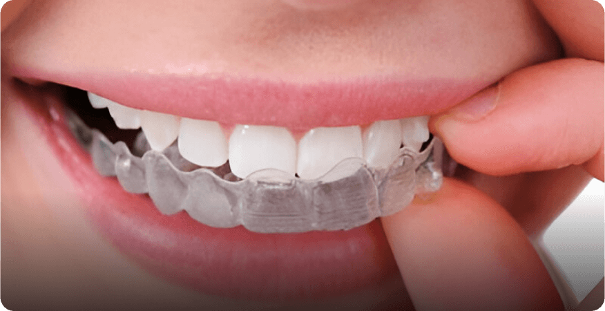 Invisible braces for adults