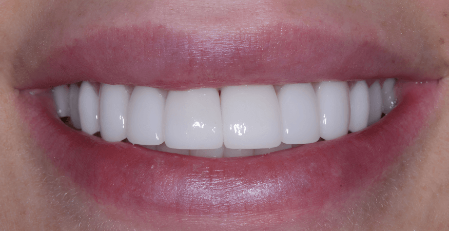 types of dental veneers