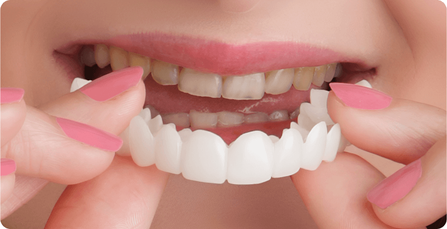 types of dental veneers