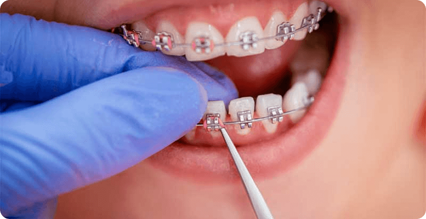 treatment for overbite teeth