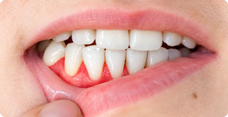 Can Gums Grow Back Naturally? ​