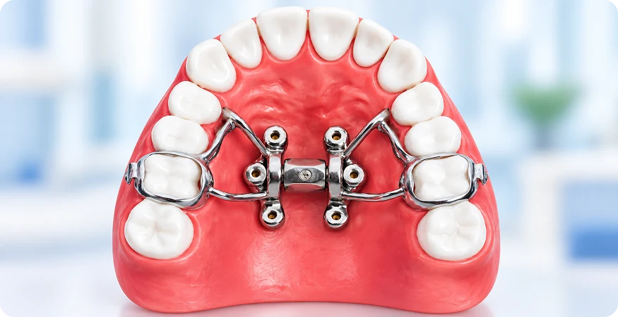 MSE (Maxillary Skeletal Expander) ​