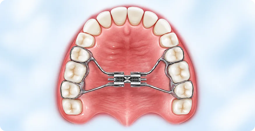 SARPE (Surgically Assisted Rapid Palatal Expansion) ​